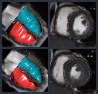 image of product سامانه Arterys Cardio AI برای تحلیل خودکار MRI قلب و اندازهگیری پارامترهای حیاتی قلبی با استفاده از هوش مصنوعی طراحی شده است.